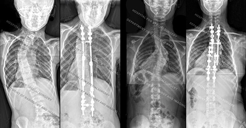 X-rays of patients with neurofibromatosis type 1 and scoliosis