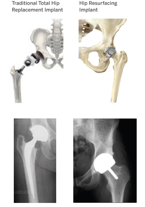 Illustrations and X-ray imaging of a tradtional hip replaement implant at left and a hip resurfacing implant at right.