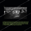 Image - Ultrasound Case 136 thumbnail
