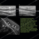 Ultrasound of the month case 156 thumbnail 