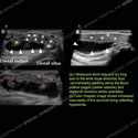 Ultrasound of the month case 157 thumbnail 