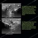 Ultrasound of the month case 158 thumbnail