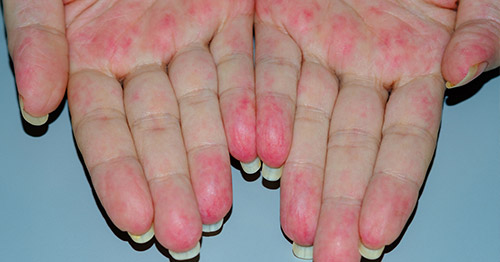 A woman's hands with hallmarks of vasculitis.