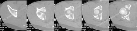 CT scans images delineate the fracture pattern from a case example presented by the orthopedic trauma service at Hospital for Special Surgery.