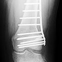 Correction of Varus Deformity of the Femur and Tibia in Patient with LCL Laxity