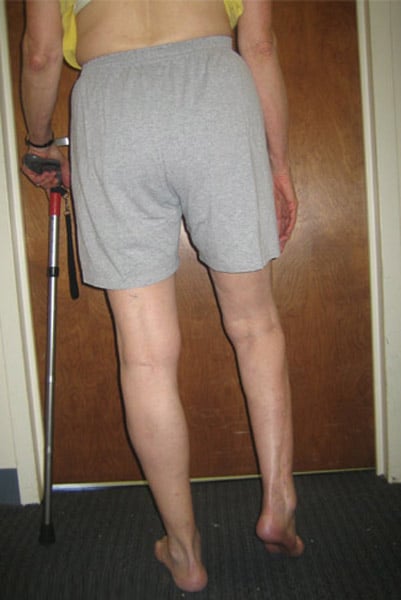 Before photo of Correction of foot deformity with ankle fusion