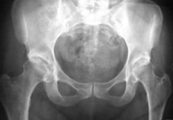 Before photo of Bilateral total hip replacement