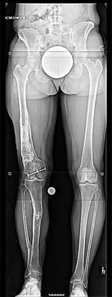 Before photo of Tibia lengthening with the LATN technique