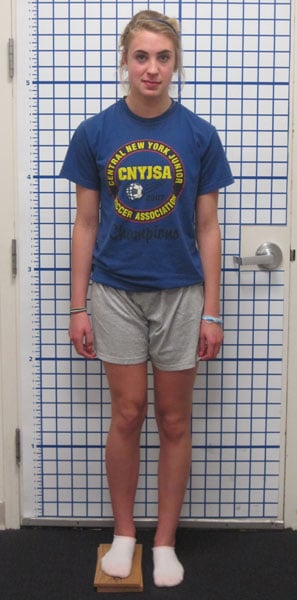 Before photo of Femur lengthening and deformity correction after growth arrest