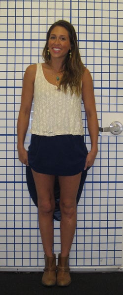 After photos of Femur lengthening and deformity correction