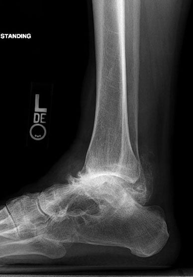 Before photo of Ankle distraction for treatment of post-traumatic arthritis Before photo  