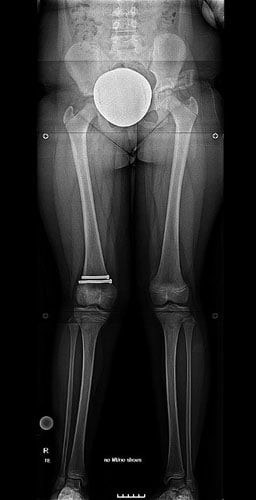 Before photo of Femur lengthening with the Precice Internal Lengthening Nail