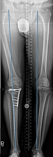 After photo of Knee Realignment and Joint Preservation
