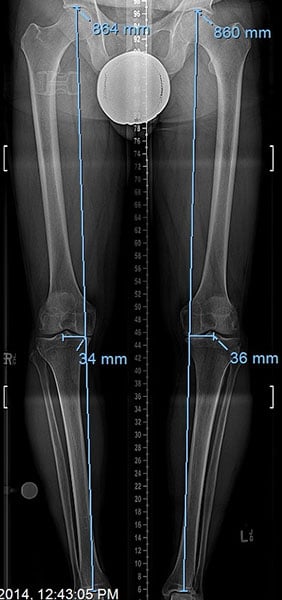 Before photo of Knee Realignment and Joint Preservation