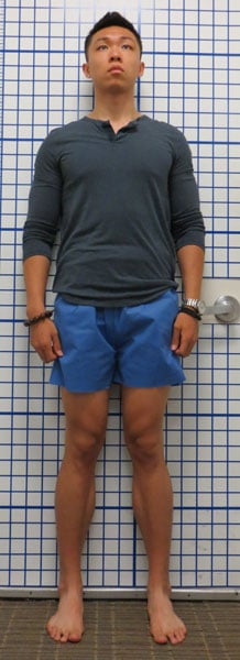 Before photo of Knock Knee