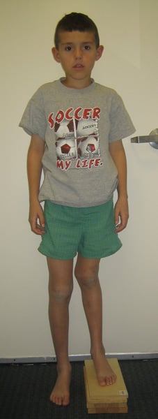 Before photo of Lengthening and correction of femur after growth arrest