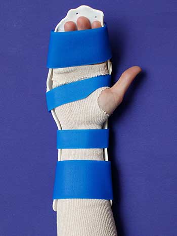 Image of left hand with orthosis top view