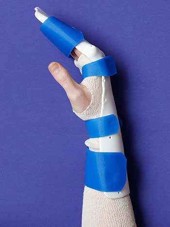Image of left hand with orthosis side view, thumb side up