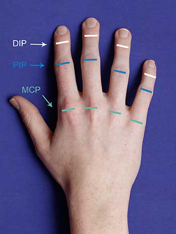 Photo of left hand top view notating DIP, PIP and MCP