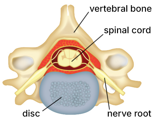 Illustration of a healthy cervical disc.