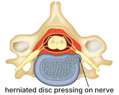 Illustration of a herniated cervical disc pressing on the nerve root.