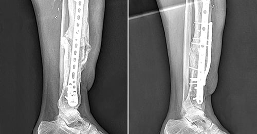 Before and after surgery X-rays of a nonunion fracture of the leg.