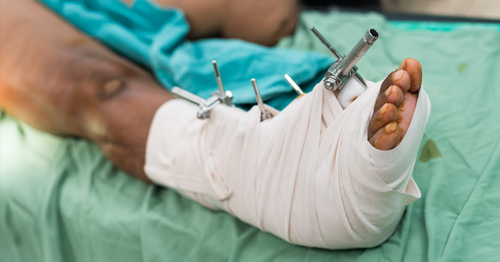 A bandaged ankle with external fracture fixation.