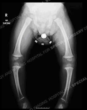an x-ray of a child with blount's disease and bow legs