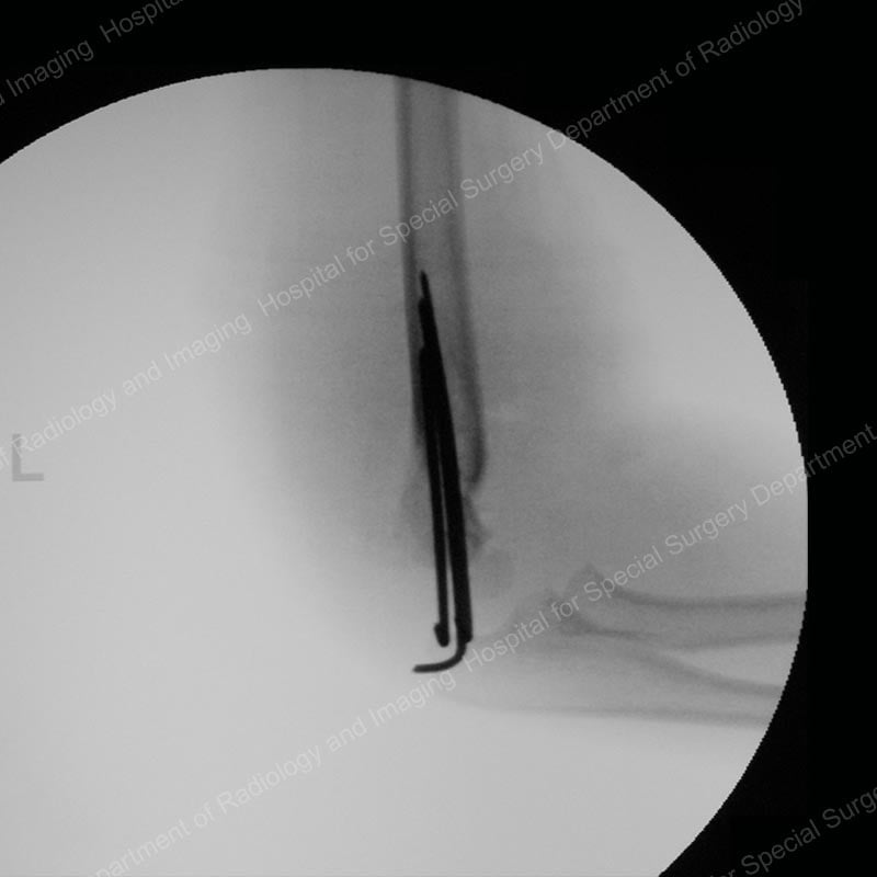 X-ray image showing supracondylar humerus fracture after treatment with realignment and wiring.