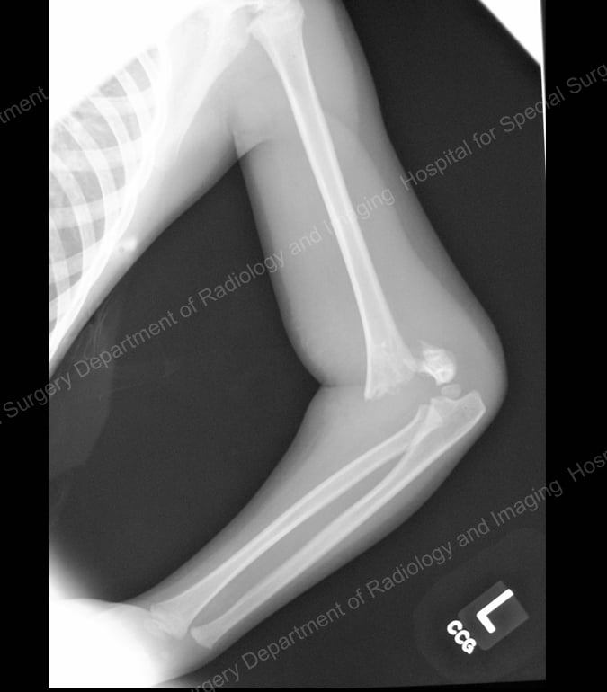 X-ray image showing supracondylar humerus fracture.