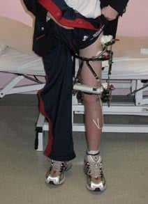 Photo of an external fixation ("ex-fix") device worn by a patient. 