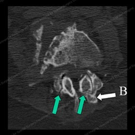 CT scan showing abnormal, osteoarthritic facet joints with thinned and irregular joint
