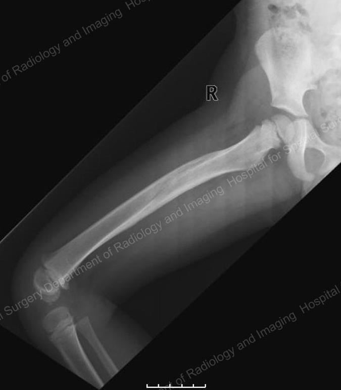 X-ray 10 months after injury and removal of spica cast.