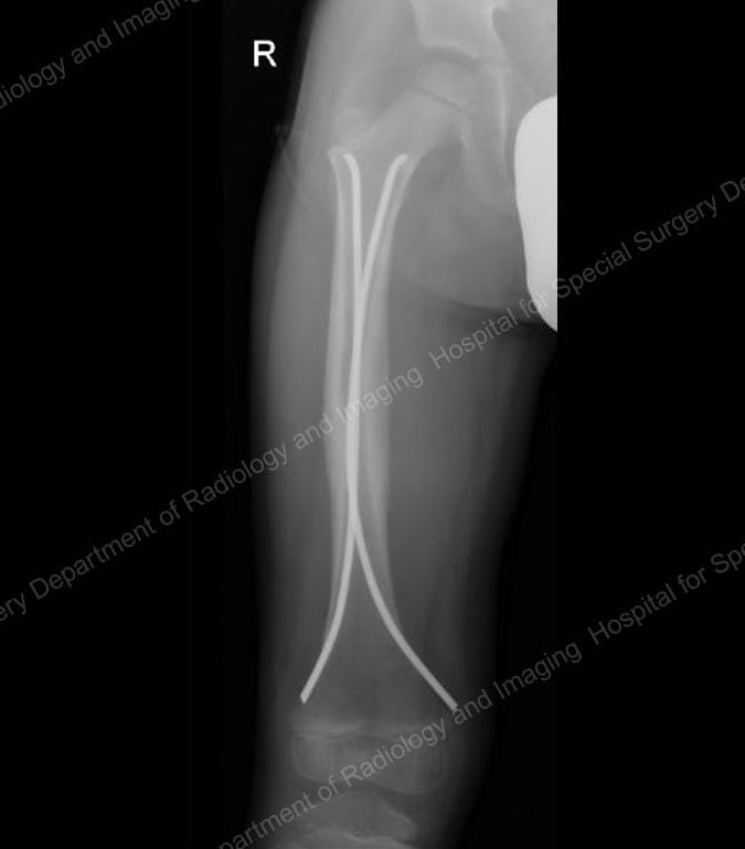 X-ray image showing flexible intramedullary nails in place.