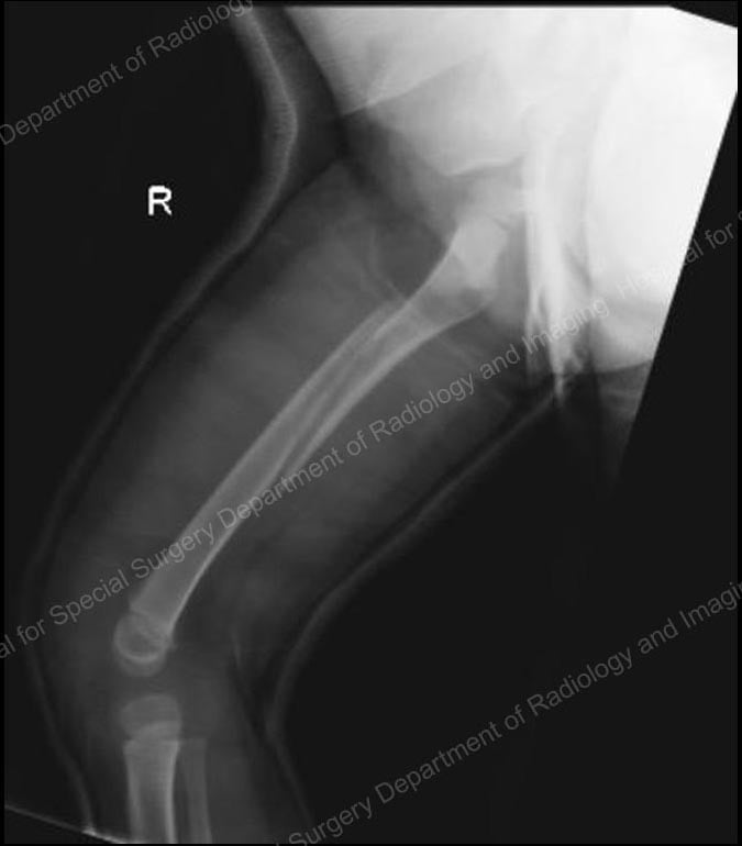 X-ray image showing femur fracture with spica cast.