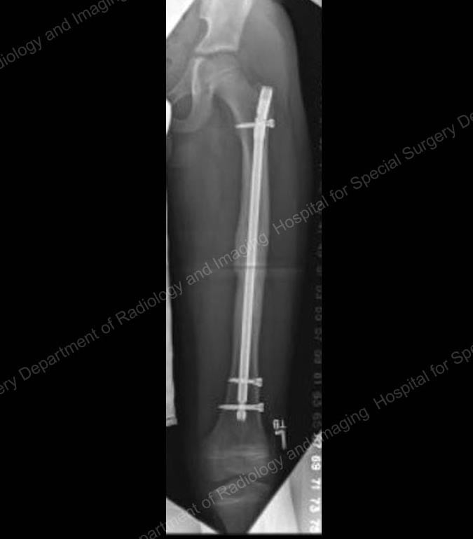 X-ray showing a rigid intramedullary nail