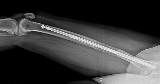 X-ray image of stature lengthening of the femur using the internal nail method