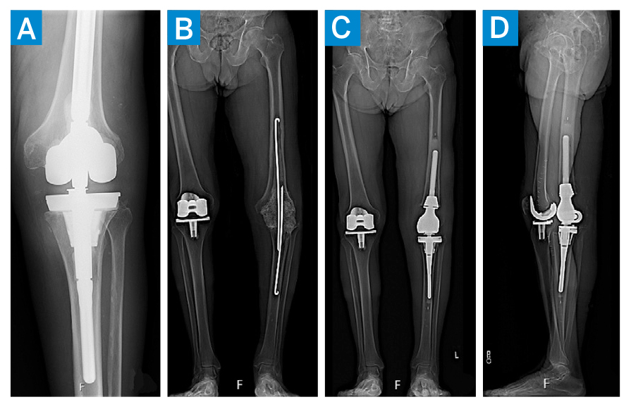 Distal Femoral Replacement Distal Femoral Replacement