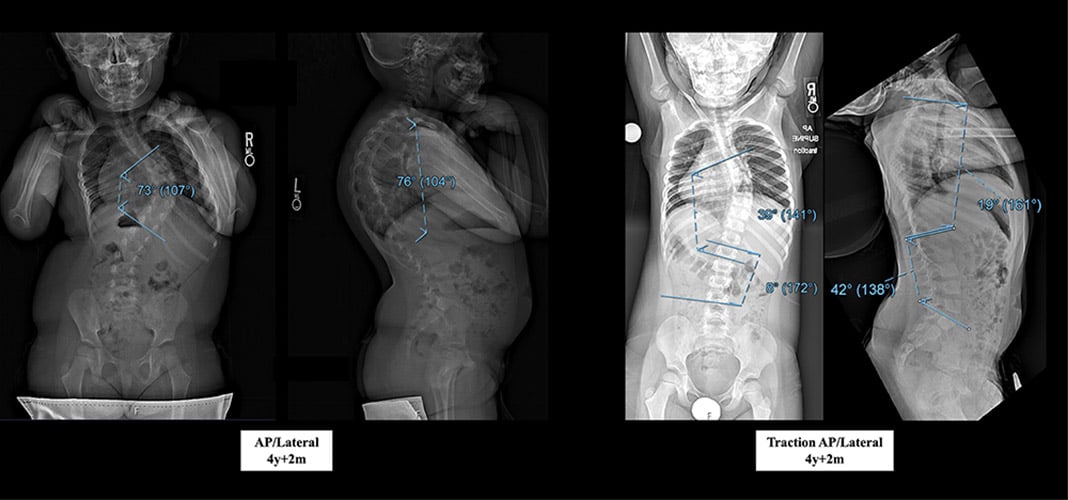 Oct complex case - Anteroposterior (AP) radiographs demonstrating scoliosis