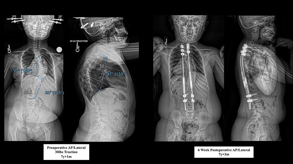 Figure 4 - Preoperative standing radiographs in 30 lbs. of skeletal traction (left); 6-week postoperative radiographs