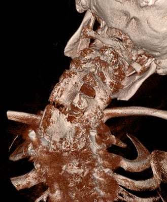 Figure 2 - 3D CT reconstruction of Spine