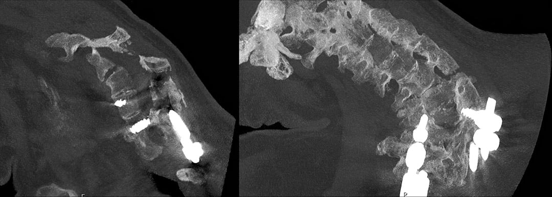 Figure 3 - Sagittal CT images of spine