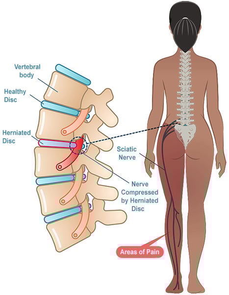 Illustration of a herniated disc compressing the sciatic nerve.