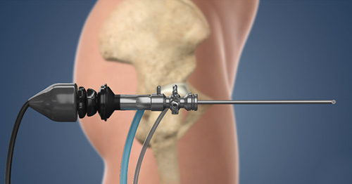 Illustration of an arthroscope.