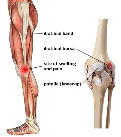 Illustration of knee joint bones and musculature with labels denoting the iliotibial band, iliotibial bursa, patella (kneecap) and site of pain and swelling in IT band syndrome