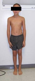 Photo of a young male limb lengthening surgery patient seven months after surgery showing an even length of his two legs.