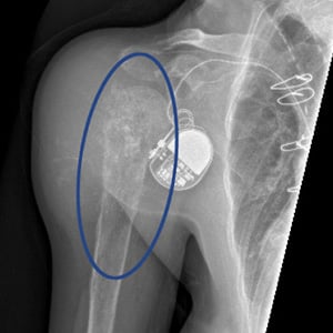 X-ray view of a chondrosarcoma (malignant bone tumor) in right proximal humerus (upper arm bone).