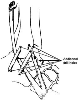 Line drawing showing peroneal substitution ligament reconstruction 