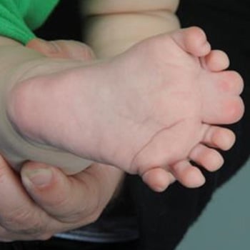 Complex synpolydactyly of the foot.