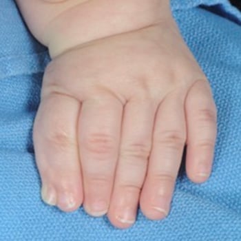 Complex synpolydactyly of the hand.